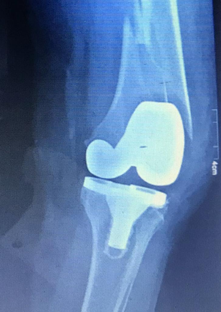 Periprosthetic Fracture (Above Knee Replacement)