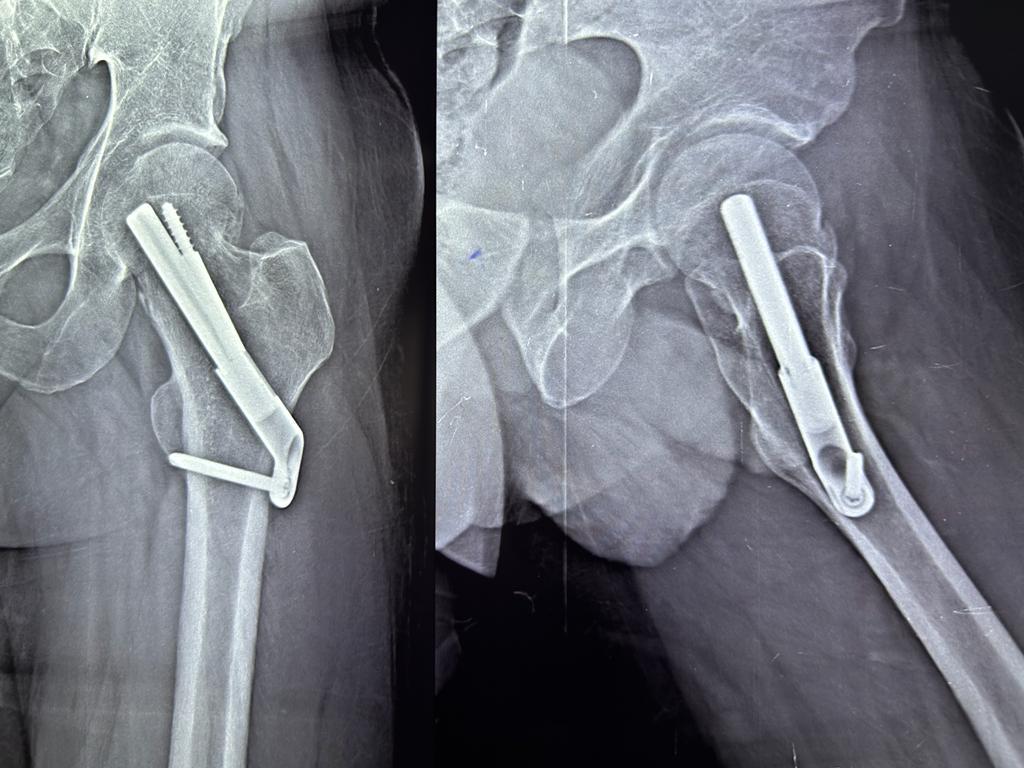 Hip Fracture Fixation with FNS