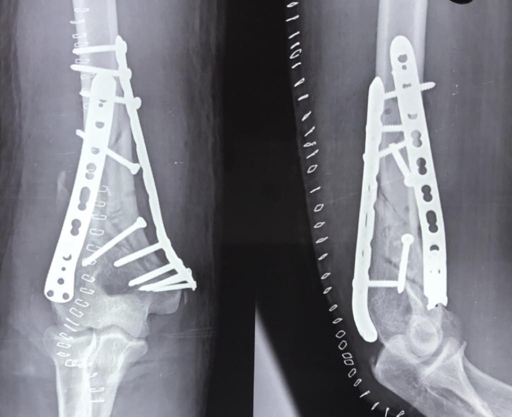 Elbow Reconstruction with Double Plating for Complex Elbow Fractures