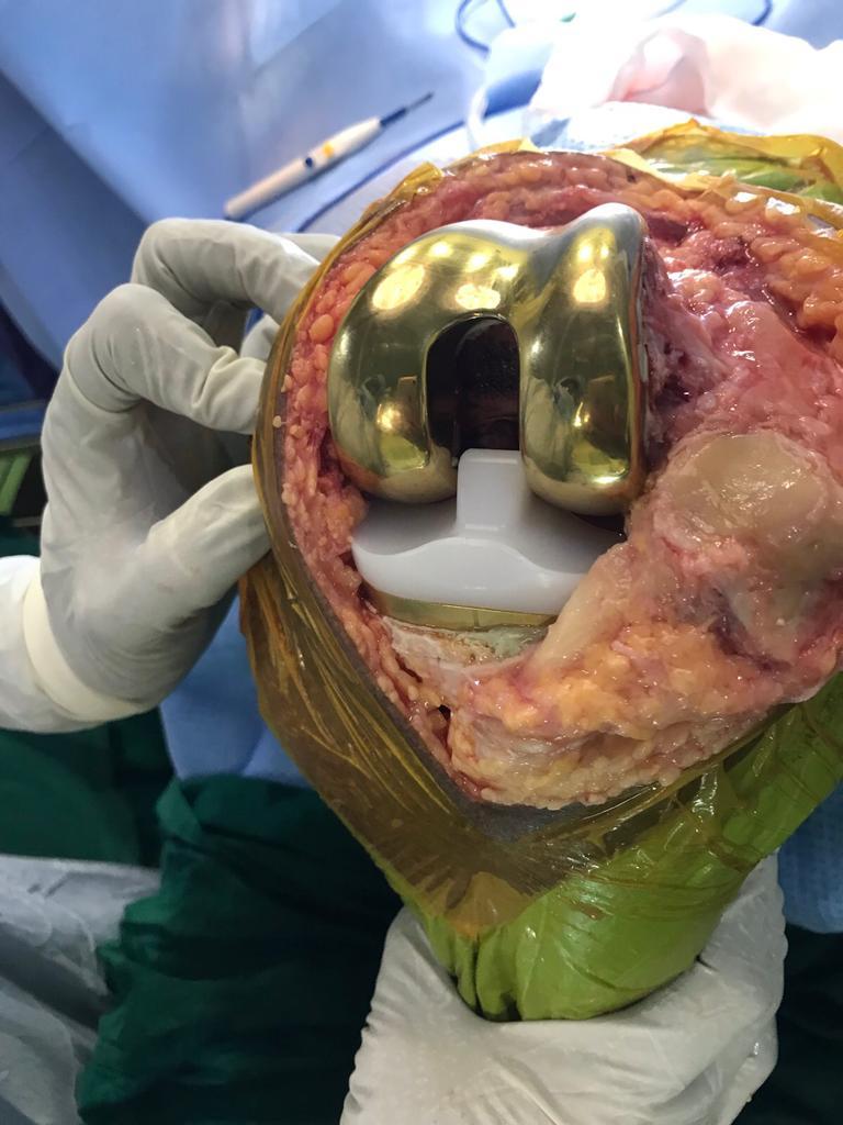 Knee Replacement - Gold