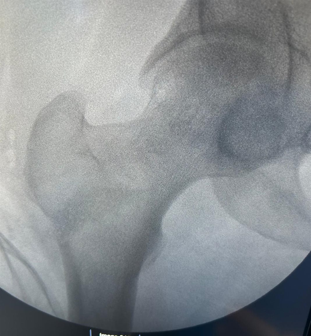 Core decompression, BMAC and bone grafting for Avascular necrosis of femoral head ( hip AVN)